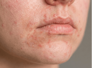 Close-up of perioral dermatitis blemishes around the mouth and chin /images/dermatitis/trail-10.png