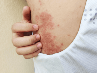 Close-up of small, rough bumps on the back of an arm /images/dermatitis/trail-12.png