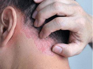 Person parting hair to show an inflamed plaque on the lower scalp /images/dermatitis/trail-9.png