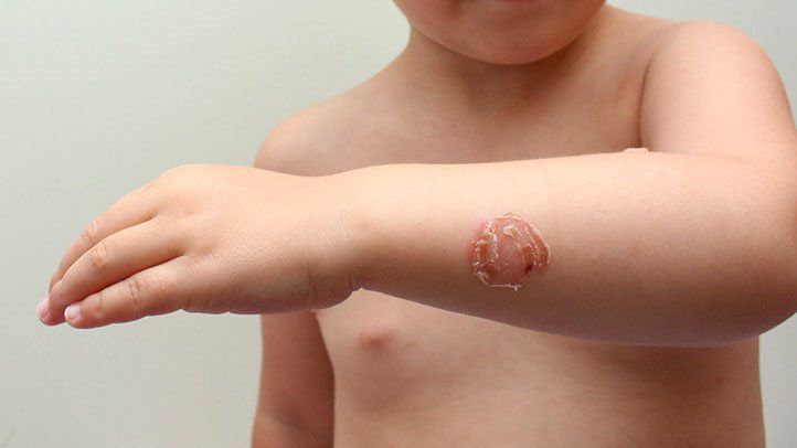 Impetigos bėrimas: gelsvi šašeliai ir paraudimas aplink burną bei nosį